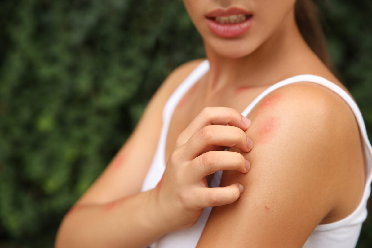 Woman scratching a bug bite on her arm.