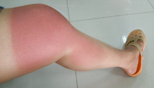 soothe your cottage sunburn