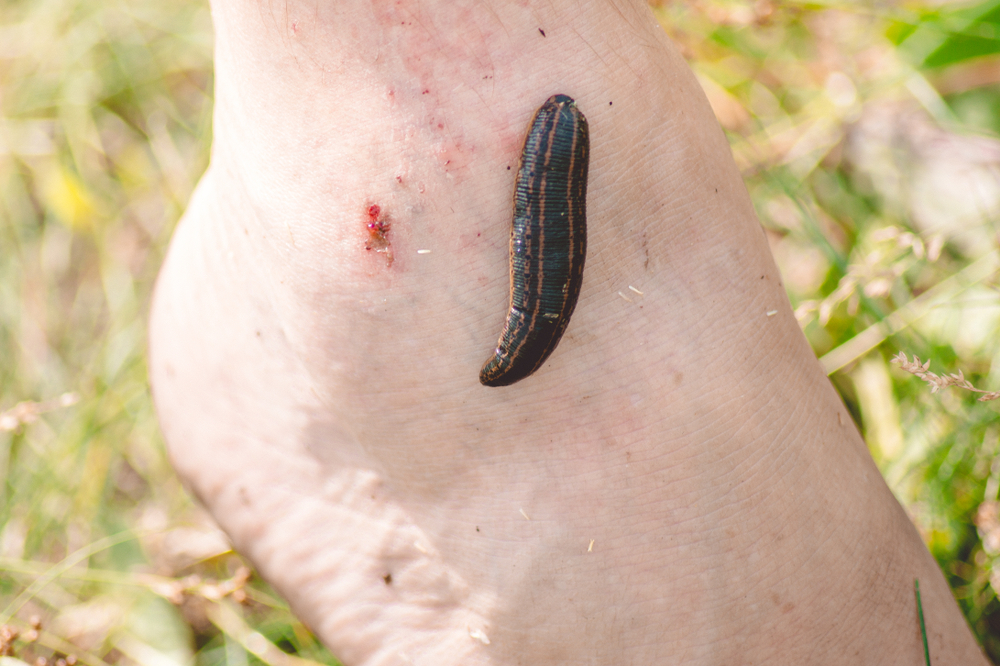 A leech stuck to a man's ankle